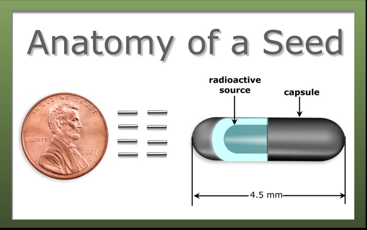 Treating Prostate Cancer Seed Implants Brachytheraphy 1048